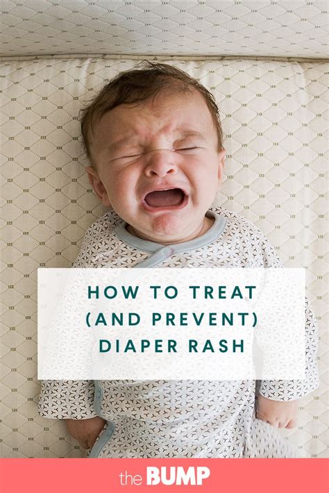 Diaper Rash How To Treat And Prevent It Diaper Rash Treatment