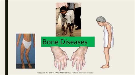 Common Bone And Muscle Injuries