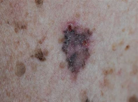 Racgp Benign Pigmented Skin Lesions