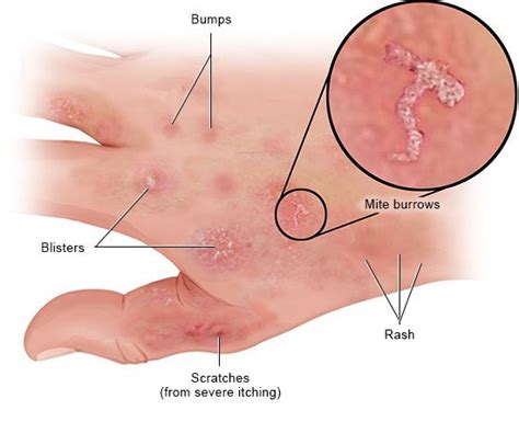 Scabies Burrows After Treatment