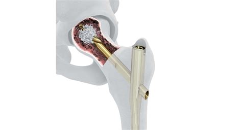 Depuy Synthes Launches New System Designed To Enhance Implant Fixation