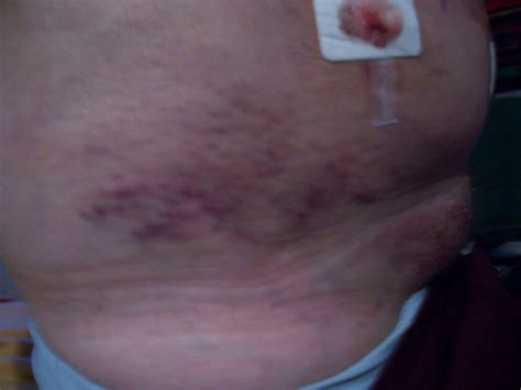 What Caused These Post Operative Complications In A Tep Inguinal Hernia