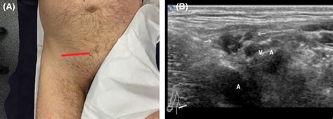 Evaluation Of Hernia Of The Male Inguinal Canal Sonographic Method Jansen 2018 Journal Of