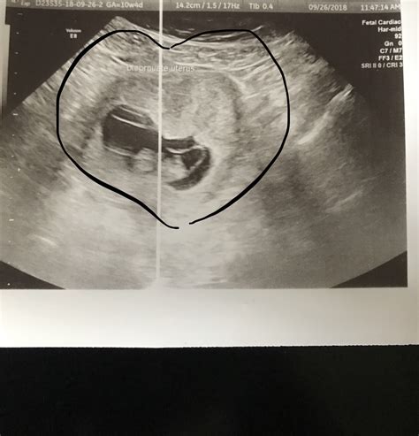 Bicornuate Uterus Heart Shaped April 2019 Babies Forums What To