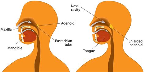 Adenoids Great Neck Adenoidectomy Nassau County Adenoid Removal