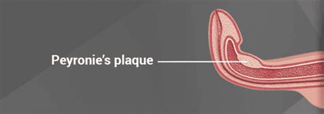 Diagram Showing Peyronies Plaque In Penis Shaft Causing Curved