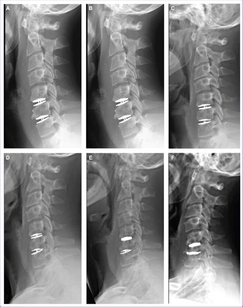 Postoperative Cervical Spine X Rays Following 2 Level Cervical