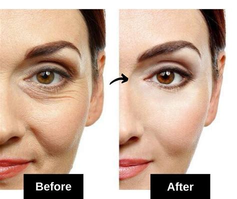 15 Most Effective Home Remedies For Under Eye Wrinkles 2020 Under