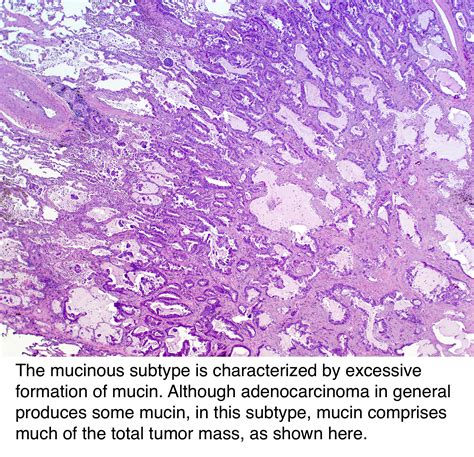 Pathology Outlines Adenocarcinoma Overview