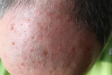 New Treatment Options For Actinic Keratosis What Does Microwave