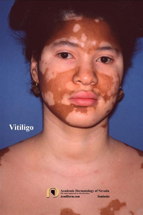 Vitiligo Leukoderma Sins Against The Sun Academic Dermatology Of Nevada
