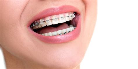 There Are Different Types Of Braces Orthodontics