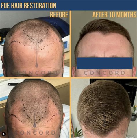What S A Neograft Hair Transplant Concord Hair Restoration
