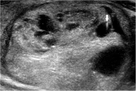 Multinodular Goiter Ultrasound