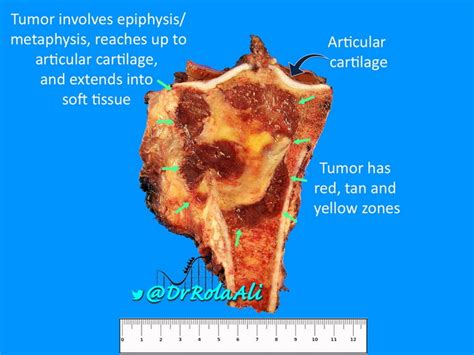 Webpathology Com A Collection Of Surgical Pathology Images