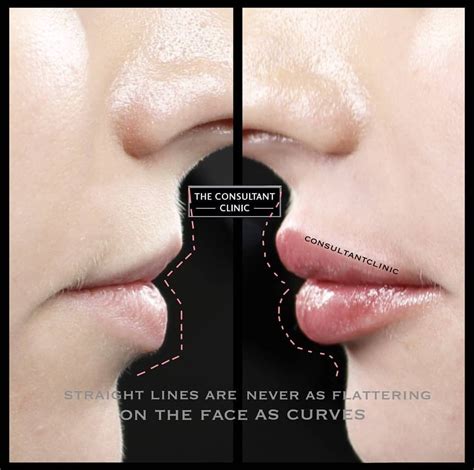 Pin By Nicole Ricks On Lips Lip Fillers Botox Lips Facial Fillers