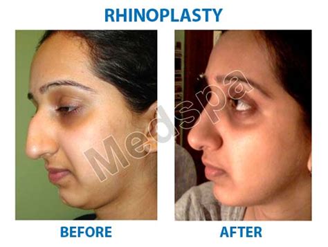 Facetouchup is the premier tool for visualizing plastic surgery results. Best Rhinoplasty Surgery in Delhi, Nose Surgery Cost in India