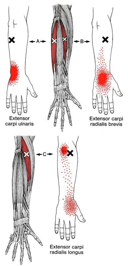 Wrist anatomy is the study of the bones, ligaments and other structures in the wrist. Extensor Carpi Radialis Longus | The Trigger Point ...