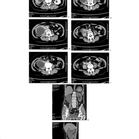 A C Contrast Enhanced Computed Tomography Showed Marked Hydronephrosis