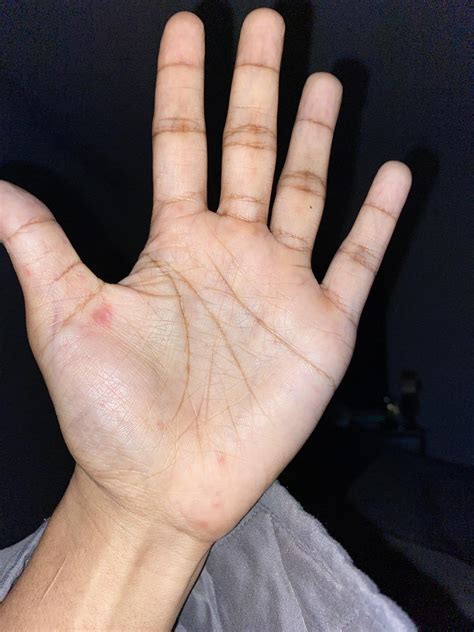Red Bumps On Palms Not Itchy Askdocs