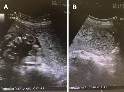 Termination Of A Partial Hydatidiform Mole And Coexisting Fetus A Case