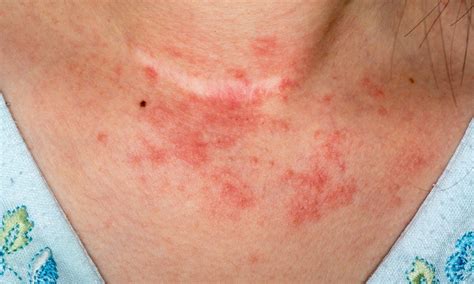 Contact Dermatitis Symptoms Treatment And More