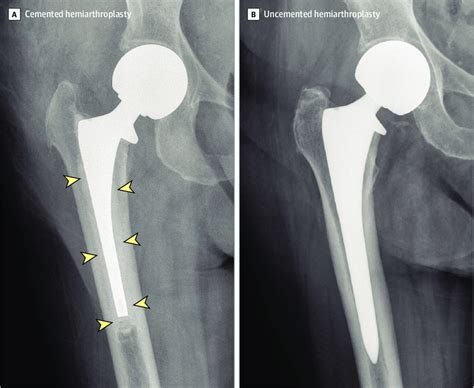 Cemented And Uncemented Hemiarthroplasty Download Scientific Diagram