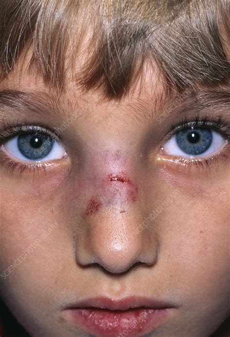 Broken Nose Stock Image M3300904 Science Photo Library