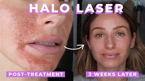 Halo Laser Treatment Review Skin Laser Youtube