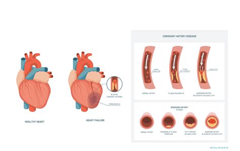 Risk Factors You Need To Know About Coronary Artery Disease Cad