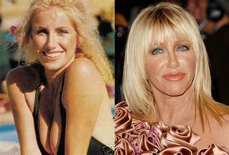 Suzanne Somers Plastic Surgery For Rise Of Popularity