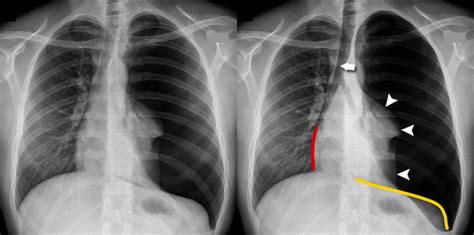 Chest X Ray Pneumothorax Gallery Tension Pneumothorax
