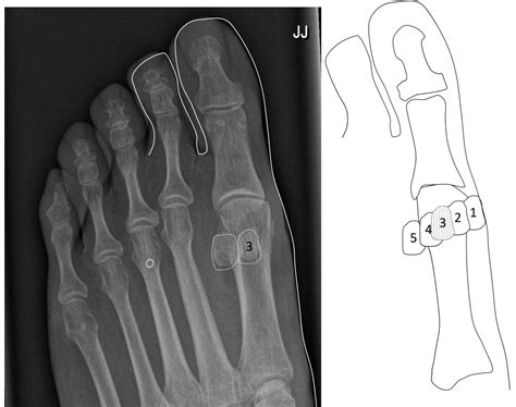 The Sesamoid Bone Consulting Footpain