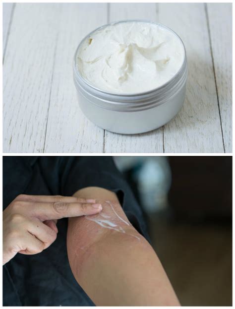 Homemade Healing Cream For Eczema And Psoriasis Home Garden Diy