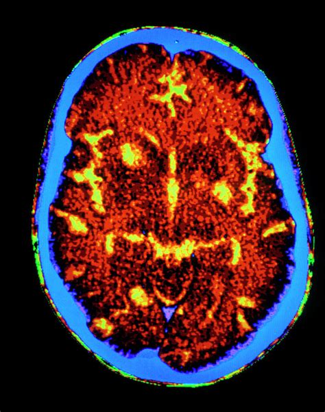 Fcol Ct Scan Of Brain With Toxoplasmosis In Aids Photograph By Gca