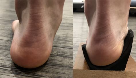 Tibialis Anterior Foot Pain