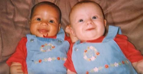 Til Of The Aylmer Twins Born With Different Colors And Appearances