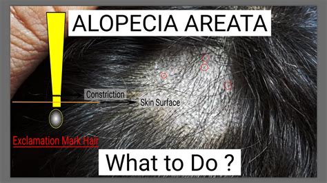 Classification of the types of androgenetic alopecia (common baldness) occurring in the female sex. Alopecia Areata - YouTube