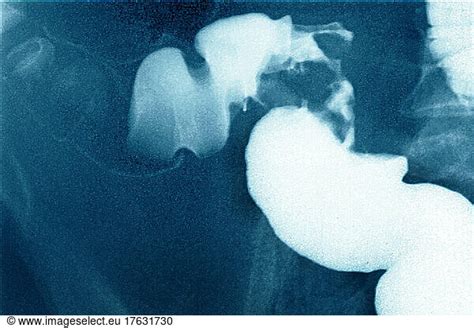 Abdominal X Ray By Barium Enema Of Colorectal Cancer Of The Sigmoid