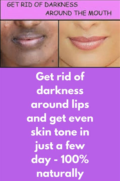 Get Rid Of Darkness Around Lips And Get Even Skin Tone In Just A Few