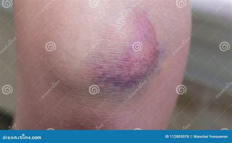 Bruise Injury On Knee Close Up Image Of Person Sitting On Sofa And