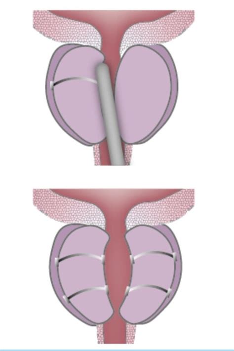 Enlarged Prostate Treatment Urolift Robotic Urology Santa Barbara Dr Pierre Alain Hueber