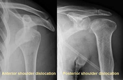 Abc Radiology Blog Shoulder Dislocation