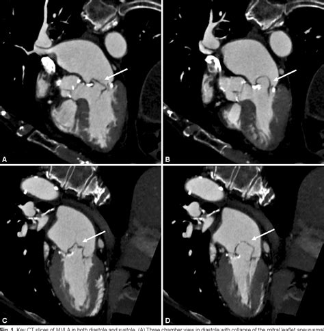 Figure 1 From Mitral Valve Leaflet Aneurysm Dynamic Ct And