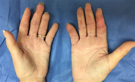 Systemic Sclerosis Scleroderma Crest Hand Surgery Source