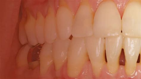 Diagnosis And Treatment Of Gingival Recession Decisions In Dentistry