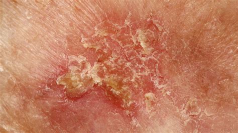 Squamous Cell Skin Cancer Diagnosis Wellesley Dermatology