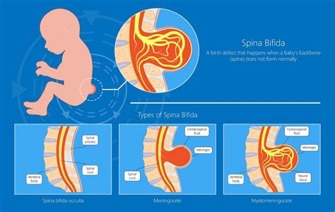 detail spina bifida occulta foto koleksi nomer 4