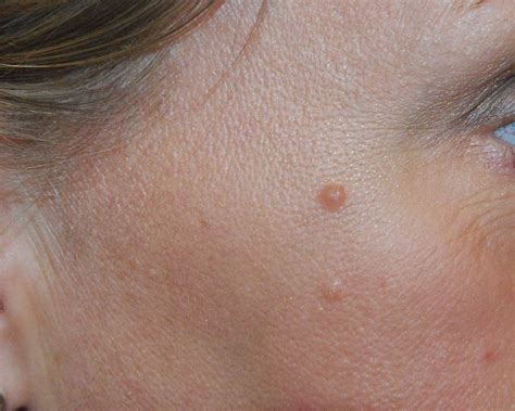 Skin Lesion Mole Removal Before And After Photos Seattle Bellevue