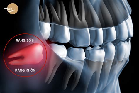 Quy Trình Nhổ Răng Khôn Gồm Các Bước Nào Nha Khoa Westway